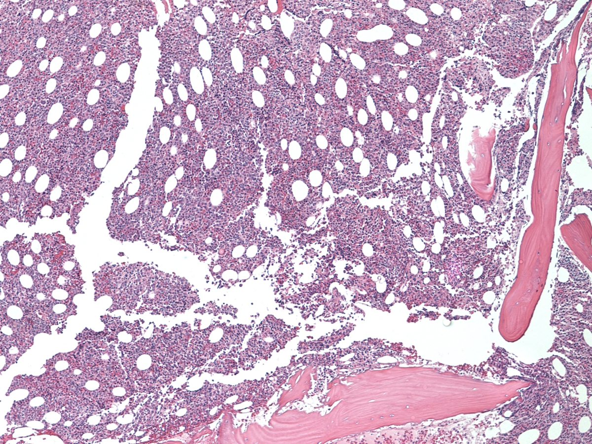 Bone marrow core biopsy, H&E, 20x. The marrow at initial diagnosis is hypercellular for age.